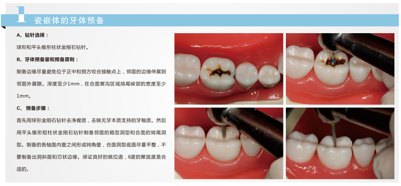 深圳全瓷牙